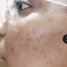 After 4 weeks — dark spots visibly lighter; skin looks more even