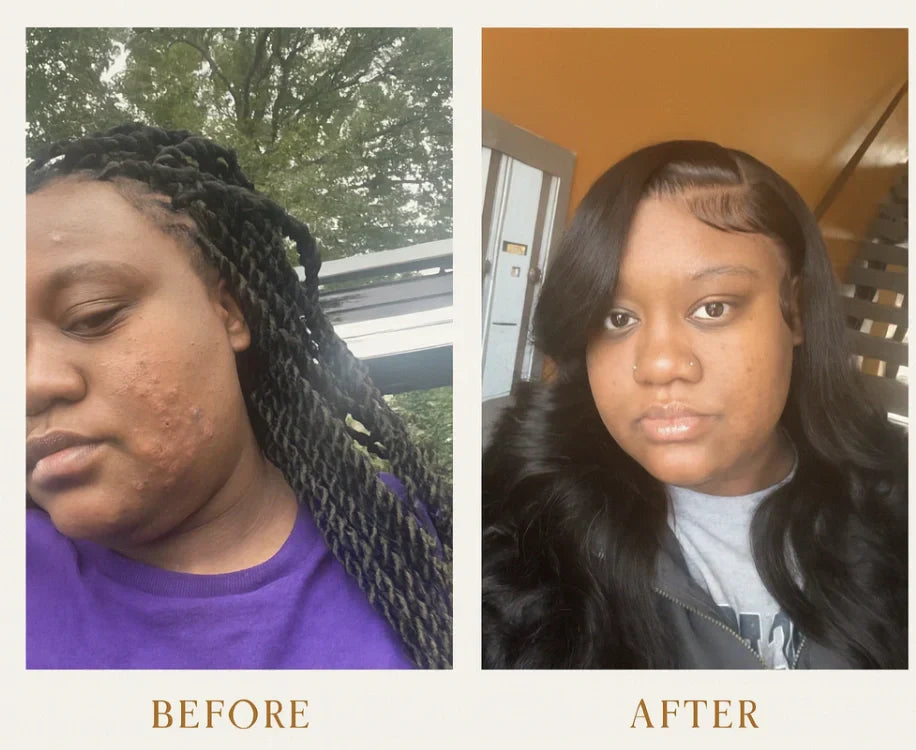 How AMVital Helped Transform Acne-Prone Skin: A Real Before & After Story