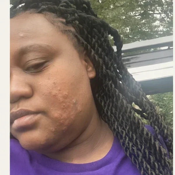 Using Turmeric Kojic Acid Soap for Acne Scars, Back Acne, and Uneven Skin Tone