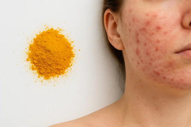Can Turmeric Cause Acne? The Shocking Truth Revealed!