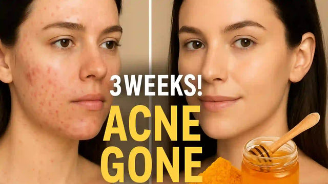 Turmeric + Honey Mask: The Perfect DIY for Acne-Prone Skin | AMVital