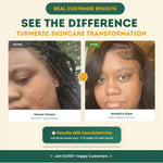 Before and after comparison of a person's skin texture with text 'See the Difference' and 'Turmeric Skincare Transformation'.