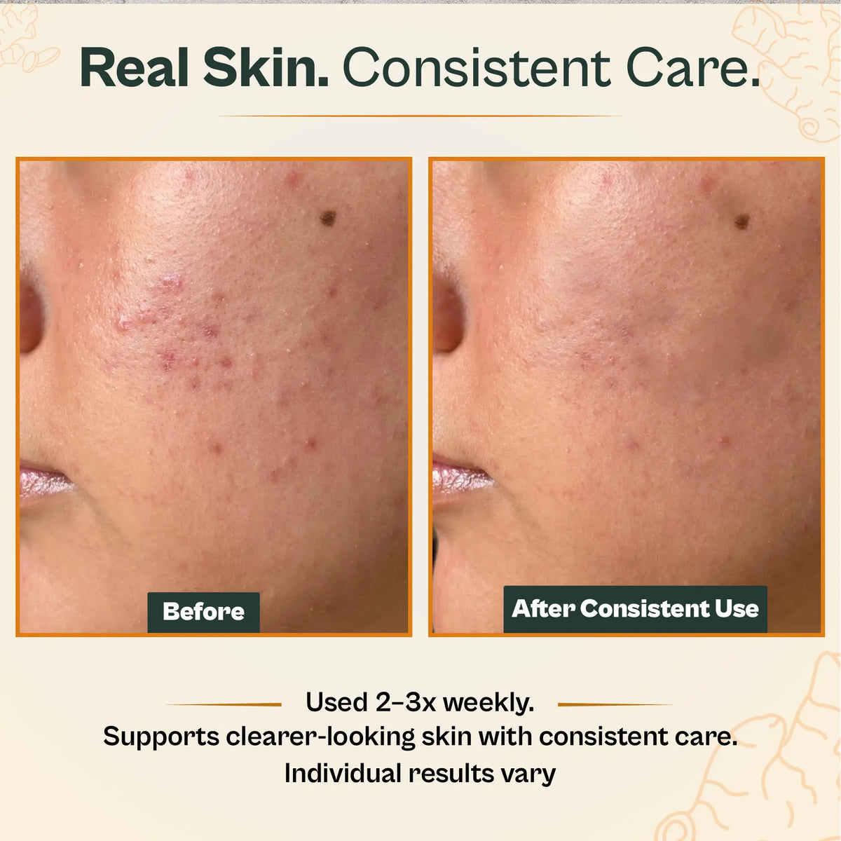 Before and after comparison of skin care product on a person's face with text about consistent use.