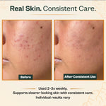 Before and after comparison of skin care product on a person's face with text about consistent use.