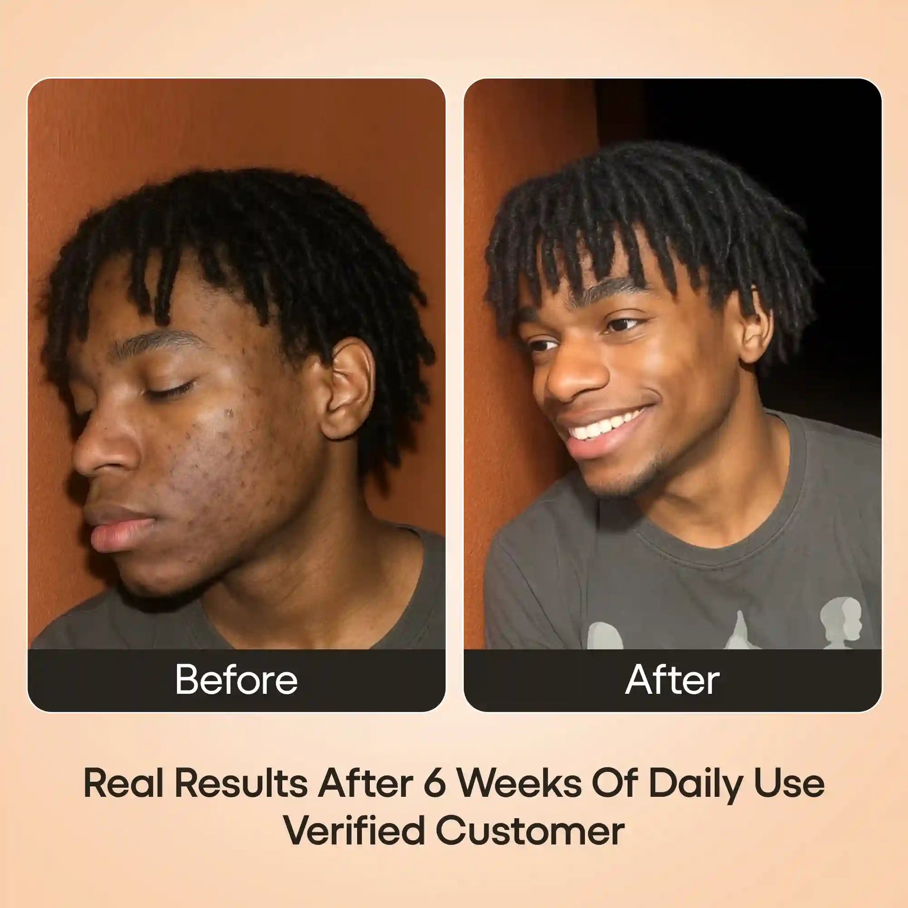 Turmeric serum for melanin-rich skin. No bleach. Real results. Free shipping $19+