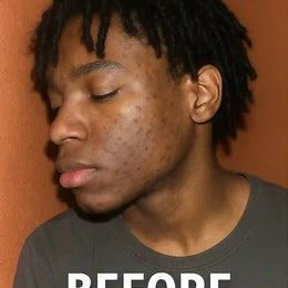 Before — cheek with dark spots