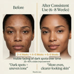 Before and after comparison of a woman's face with text indicating visible dark spot fading over time.
