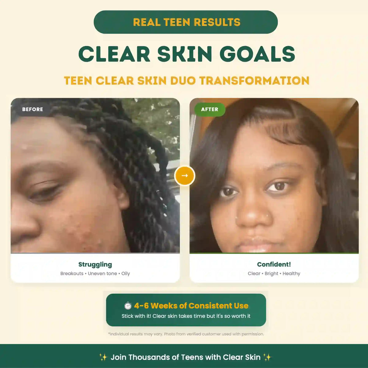 Before and after transformation of a teen's skin with text about clear skin goals and product use.