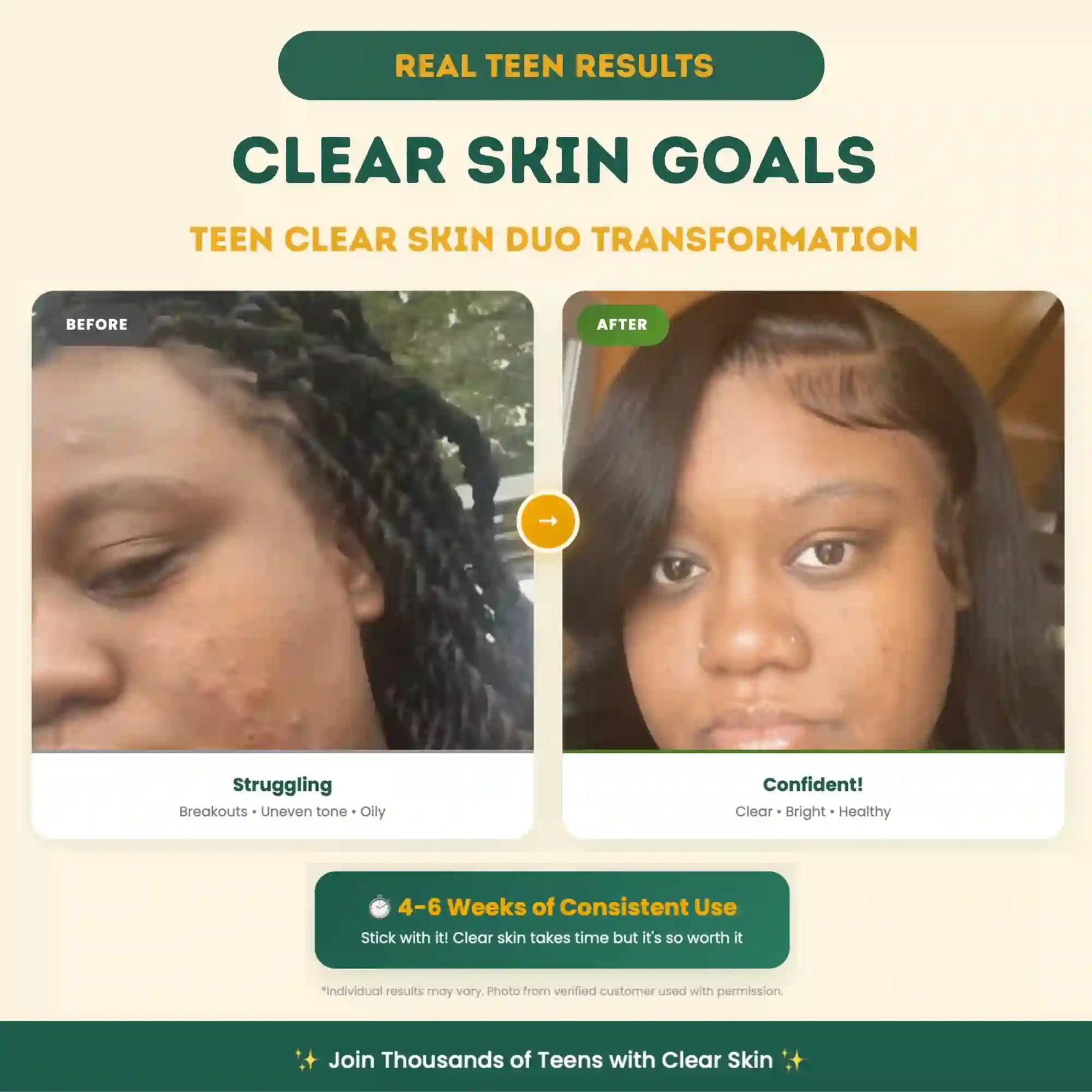 Before and after transformation of a teen's skin with text about clear skin goals and product use.