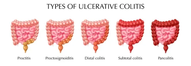 turmeric for ulcerative colitis