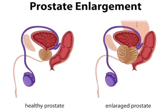 turmeric for prostate