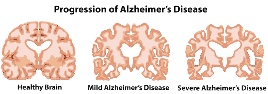 ginseng prevent Alzheimer's disease