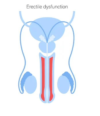 ginseng may improve erectile dysfunction