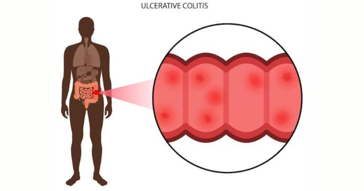 ulcerative colitis