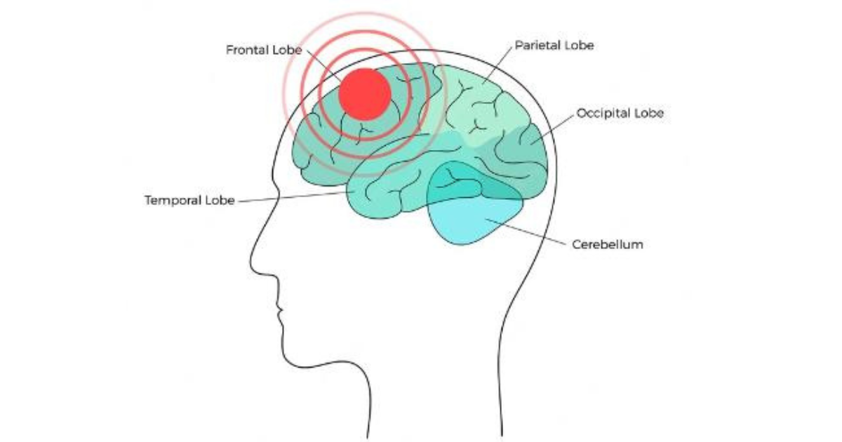 curcumin for migraines