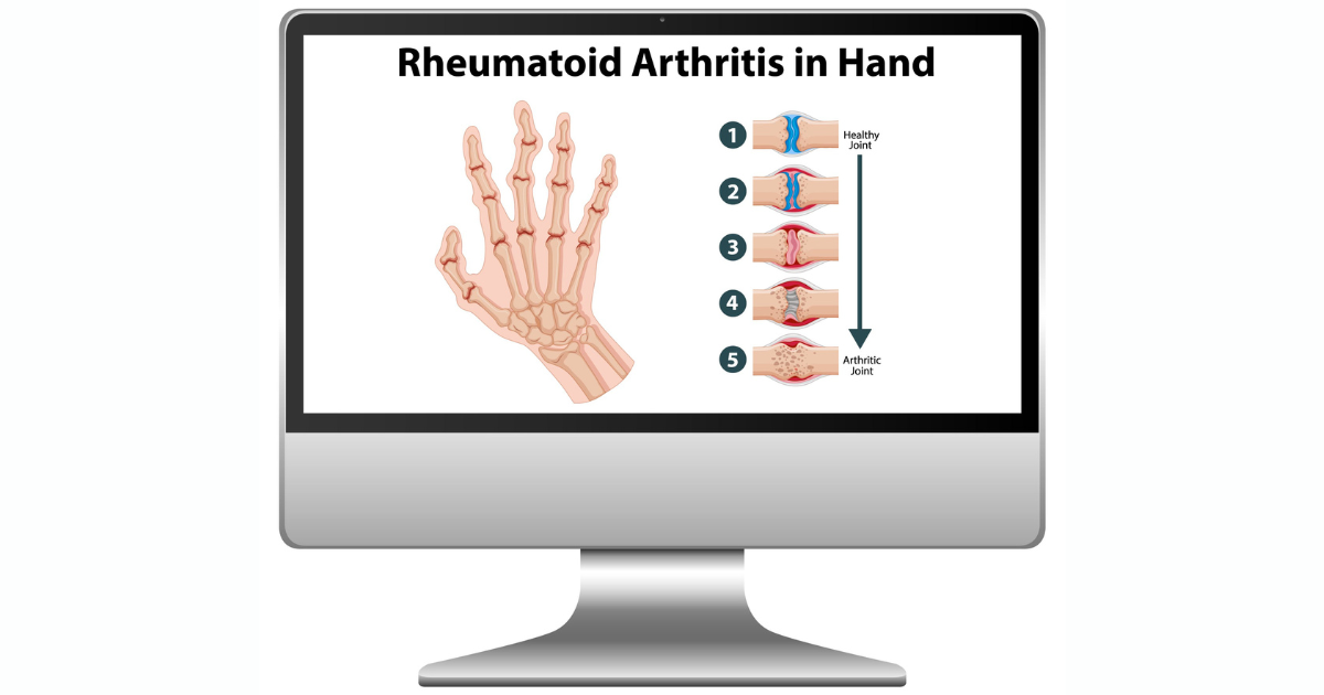 rheumatoid arthritis