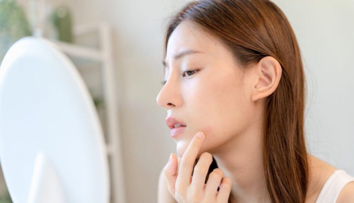 The woman has acne on her face.