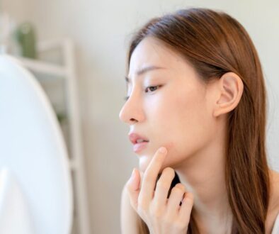 The woman has acne on her face.