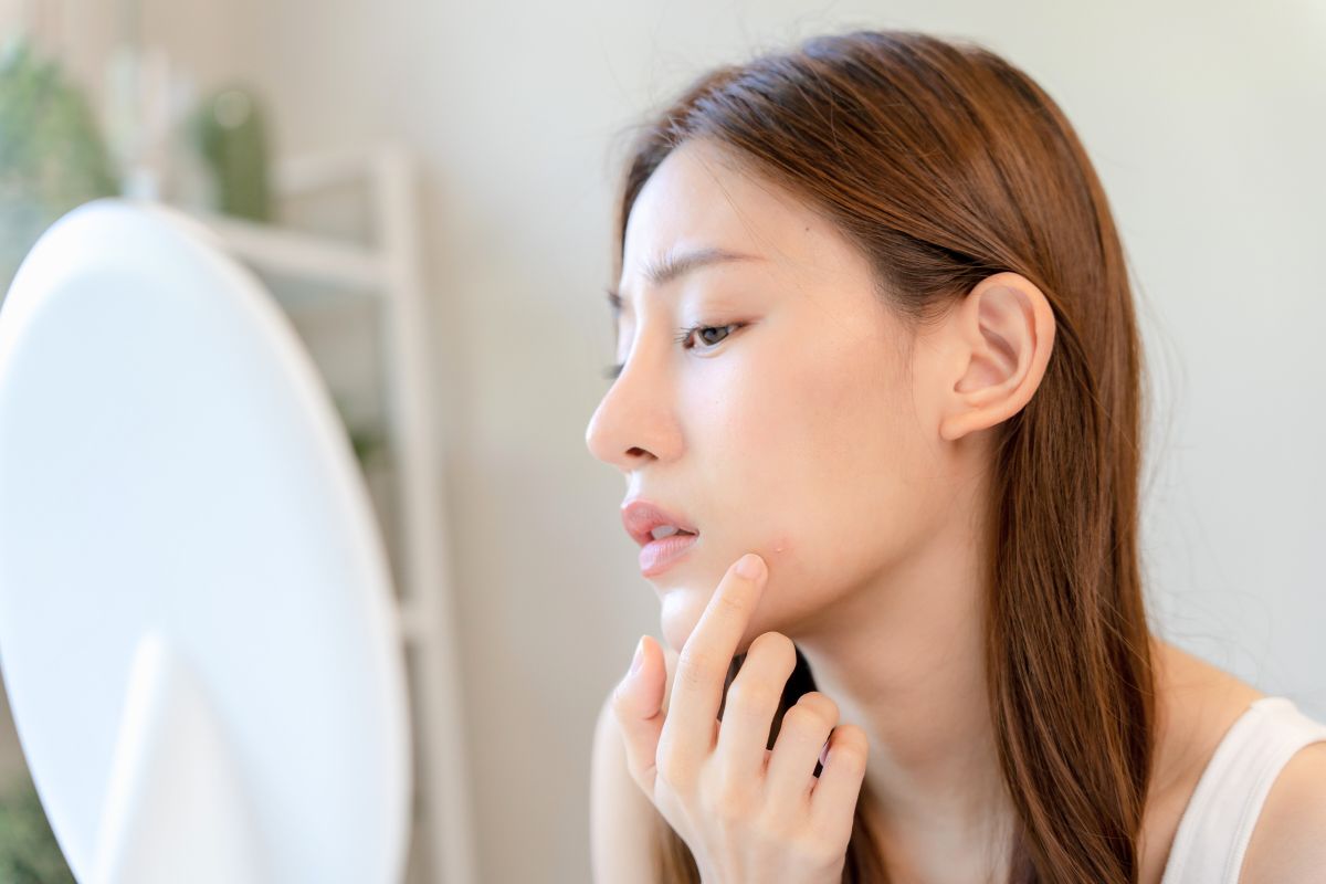 can turmeric cause acne (2) The woman has acne on her face.